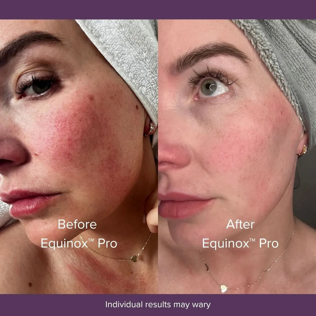 Equinox™ Pro LED Mask
